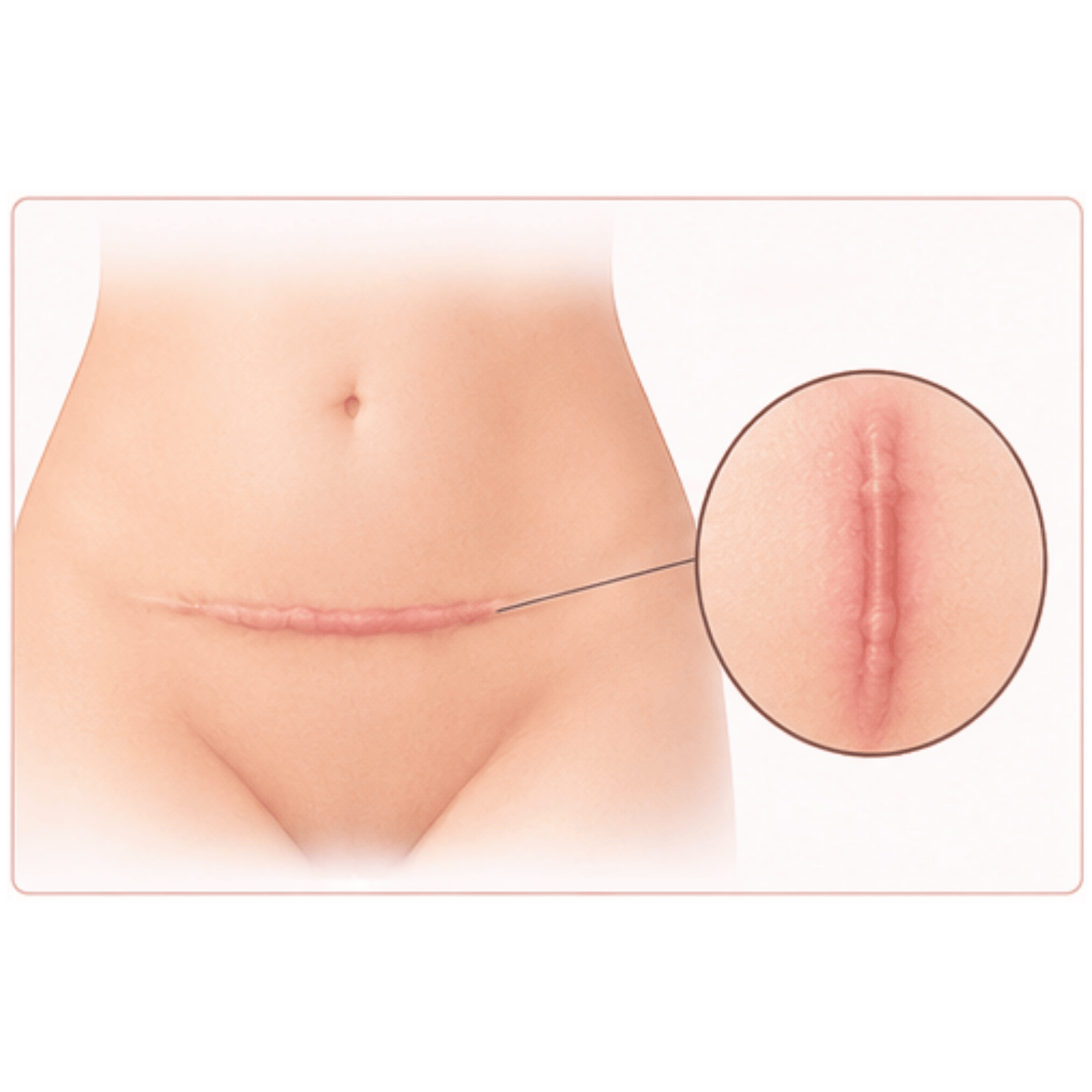 Post Delivery Scar Revision | Shree Women's Clinic