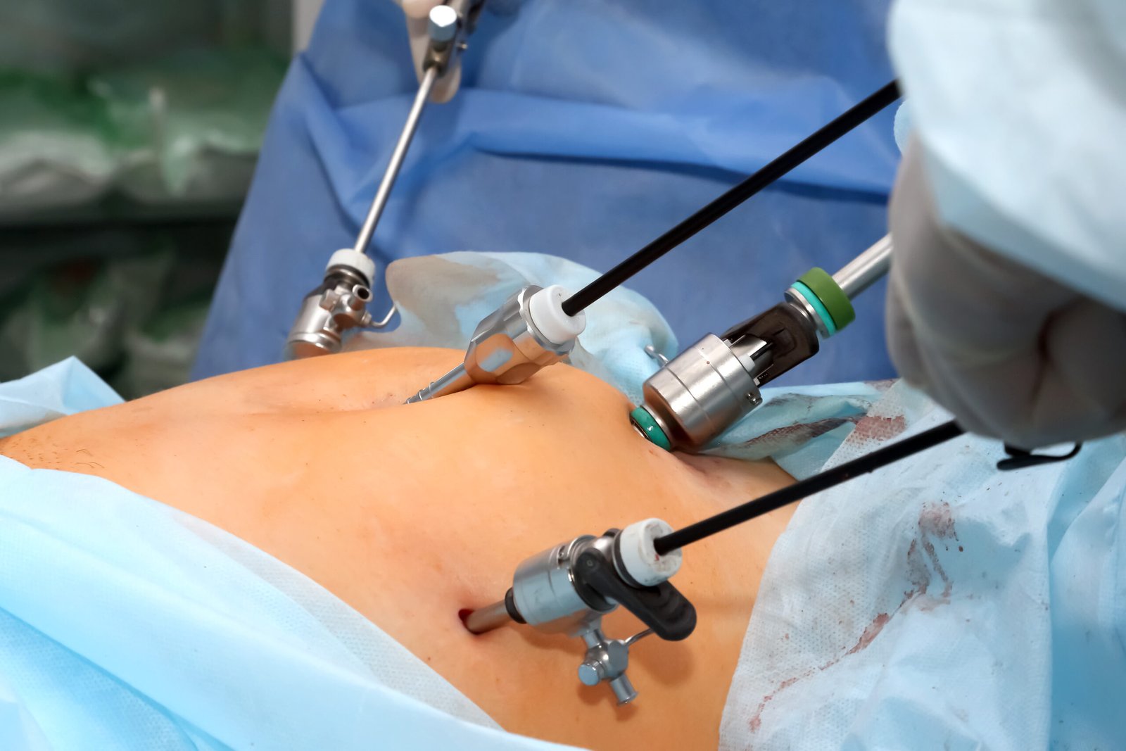 laparoscopic | Shree Women's Clinic